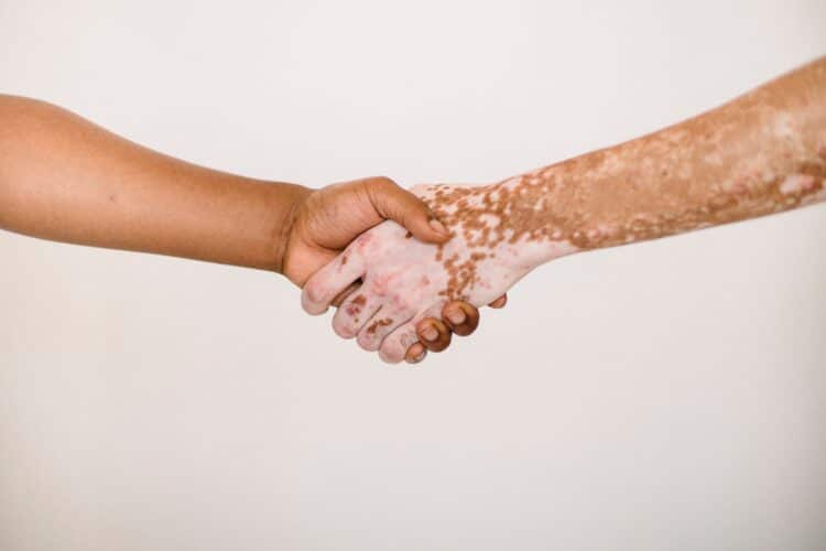 1-vitiligo-1