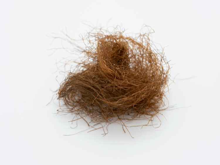 1 az eltűnő tincsek nyomában – az alopecia