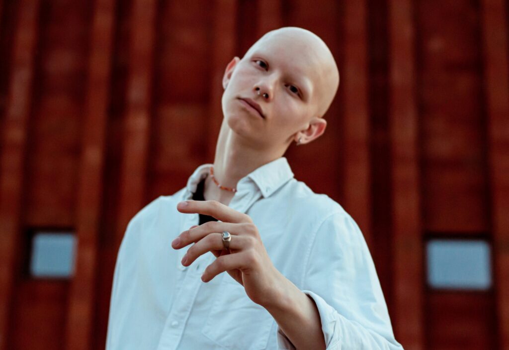 2 az eltűnő tincsek nyomában – az alopecia
