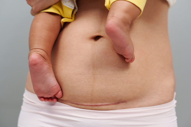 Belly of woman with c section scar of caesarean. mother holding her baby