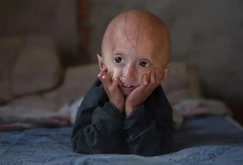 Progeria 2.