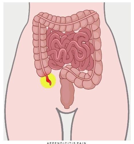 Appendicitis 1