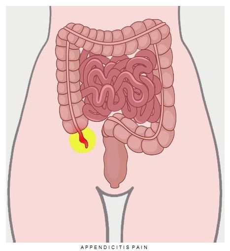 Appendicitis 1