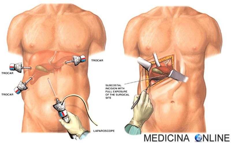 Appendicitis 2.