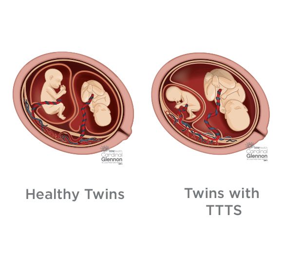 Ttts2